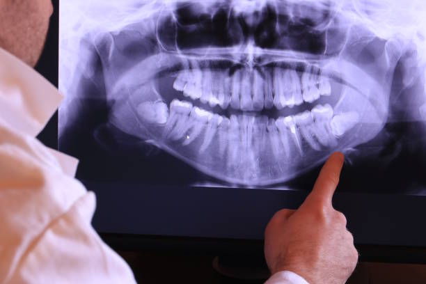 Best Knocked-Out Tooth (Avulsed Tooth) Treatment in Middletown, IN